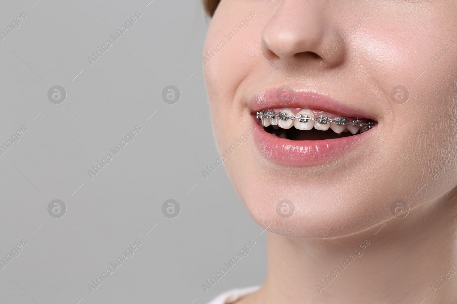 Photo of Smiling woman with dental braces on grey background, closeup. Space for text