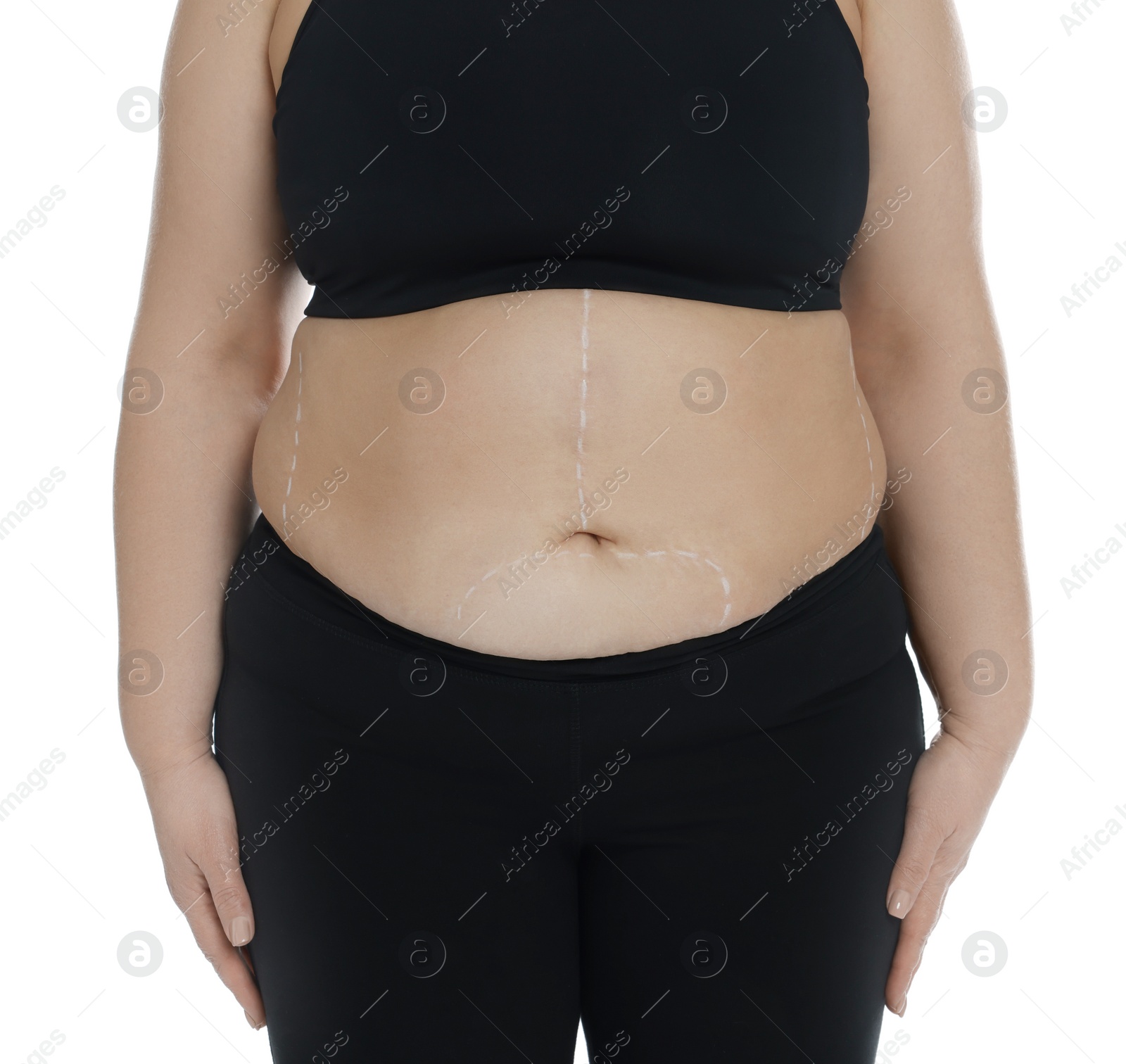 Photo of Obese woman with marks on body against white background, closeup. Weight loss surgery