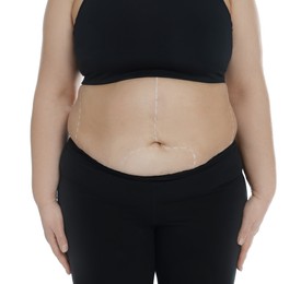 Obese woman with marks on body against white background, closeup. Weight loss surgery
