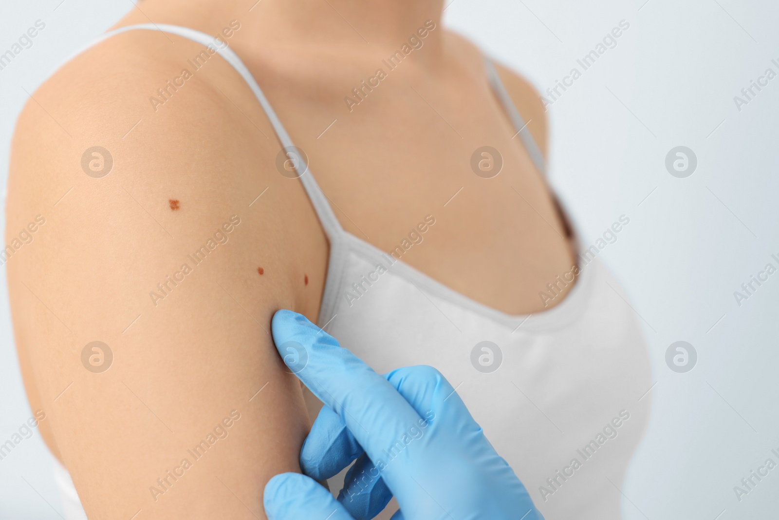 Photo of Dermatologist examining patient's birthmark on beige background, closeup