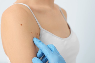 Dermatologist examining patient's birthmark on beige background, closeup