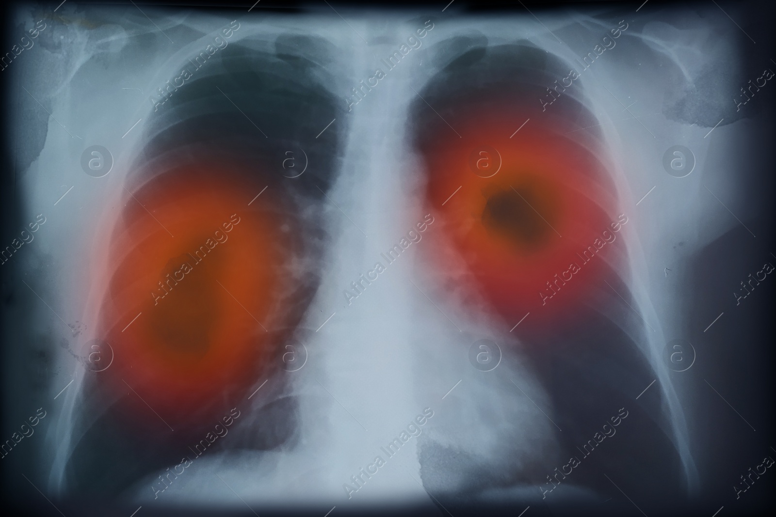 Illustration of X-ray image of patient with lung cancer. Illustration