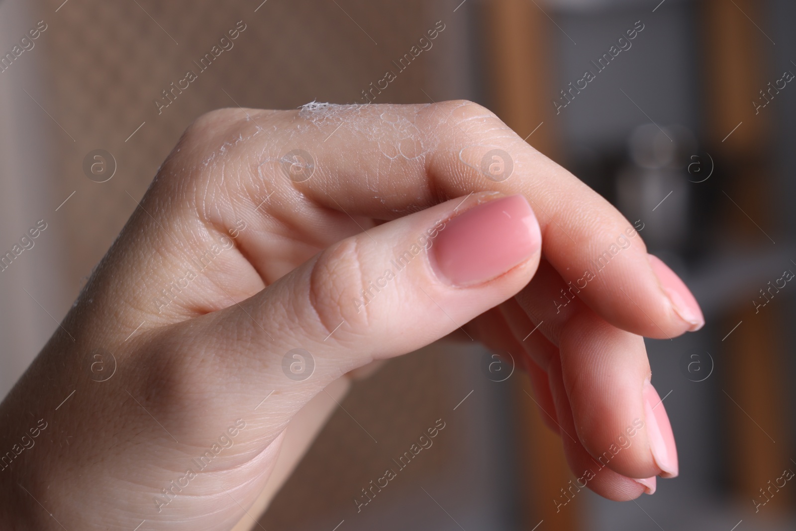 Photo of Woman with dry skin on hand against blurred background, macro view