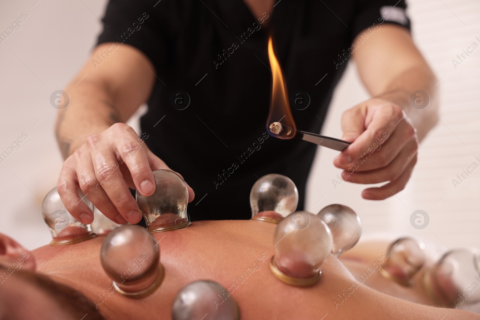 Photo of Therapist giving fire cupping treatment to patient indoors, closeup