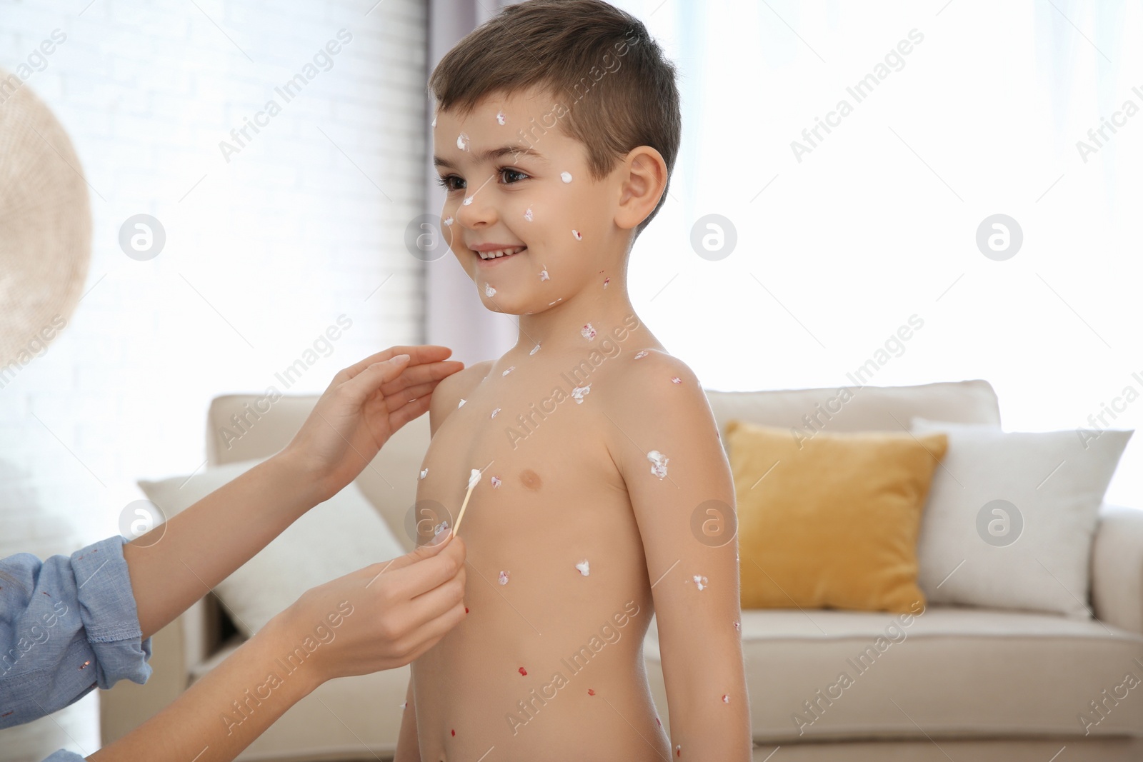 Photo of Woman applying cream onto skin of little boy with chickenpox at home