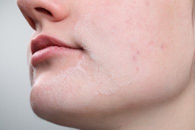 Woman with dry skin on face against light background, closeup