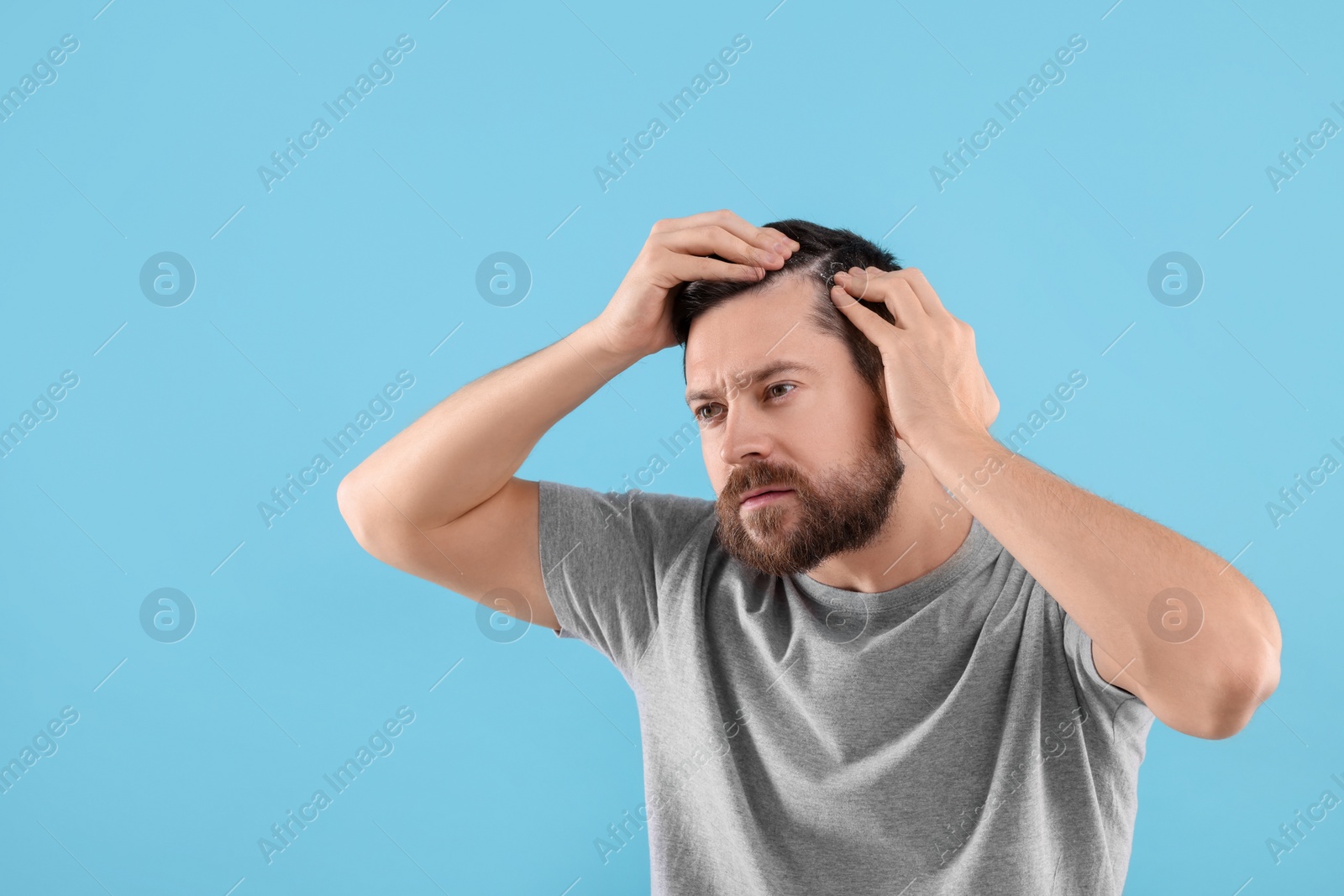 Photo of Man with dandruff in his dark hair on light blue background, space for text