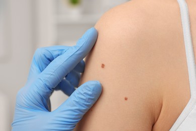 Dermatologist examining patient's birthmark indoors, closeup view