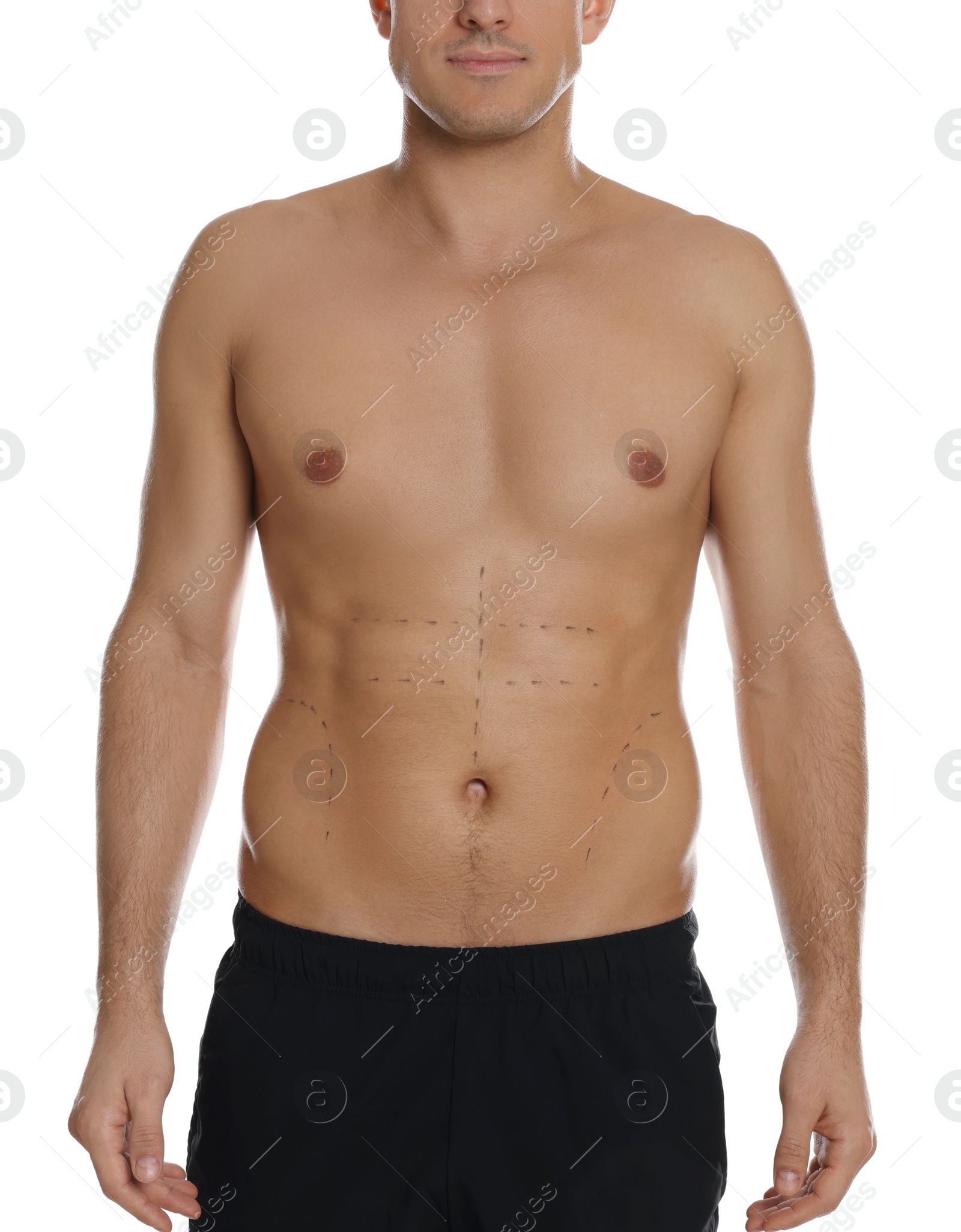 Photo of Fit man with marks on body against white background, closeup. Weight loss surgery