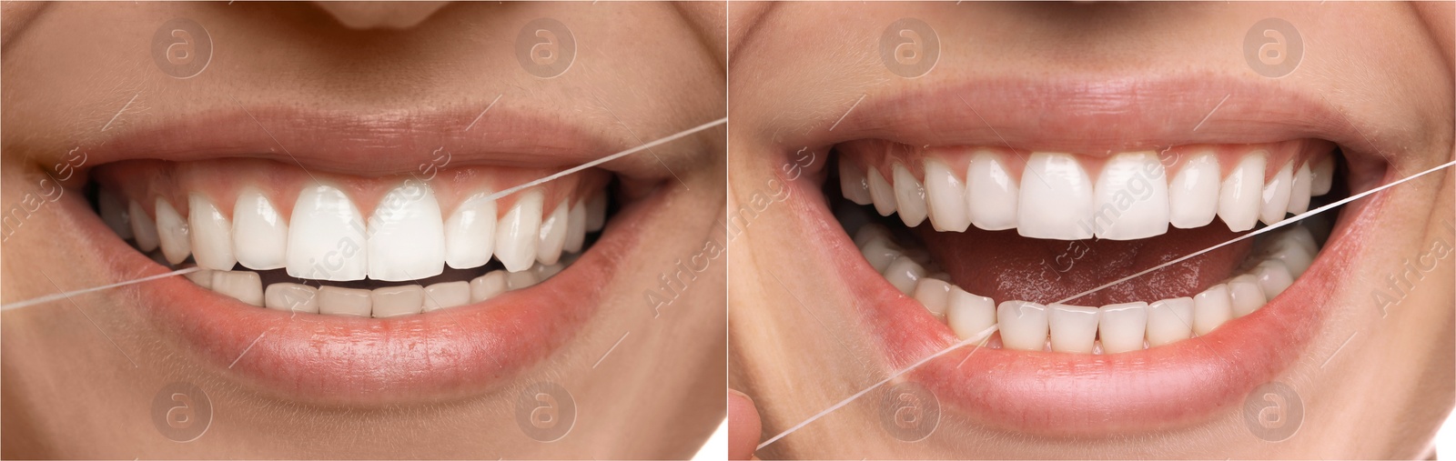 Image of Collage with photos of woman using dental floss, closeup. Step by step instructions