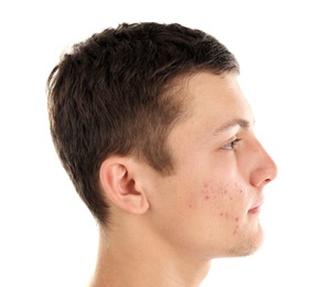 Photo of Young man with acne problem on white background