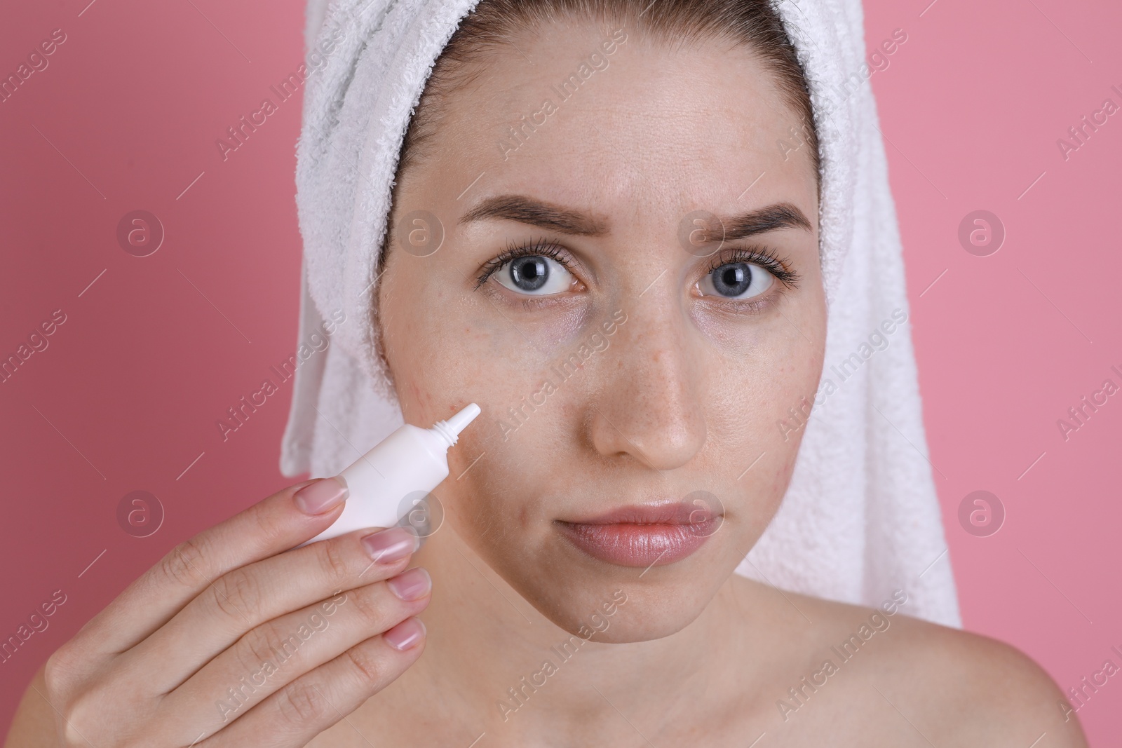 Photo of Young woman with acne problem applying cosmetic product onto her skin on pink background, closeup