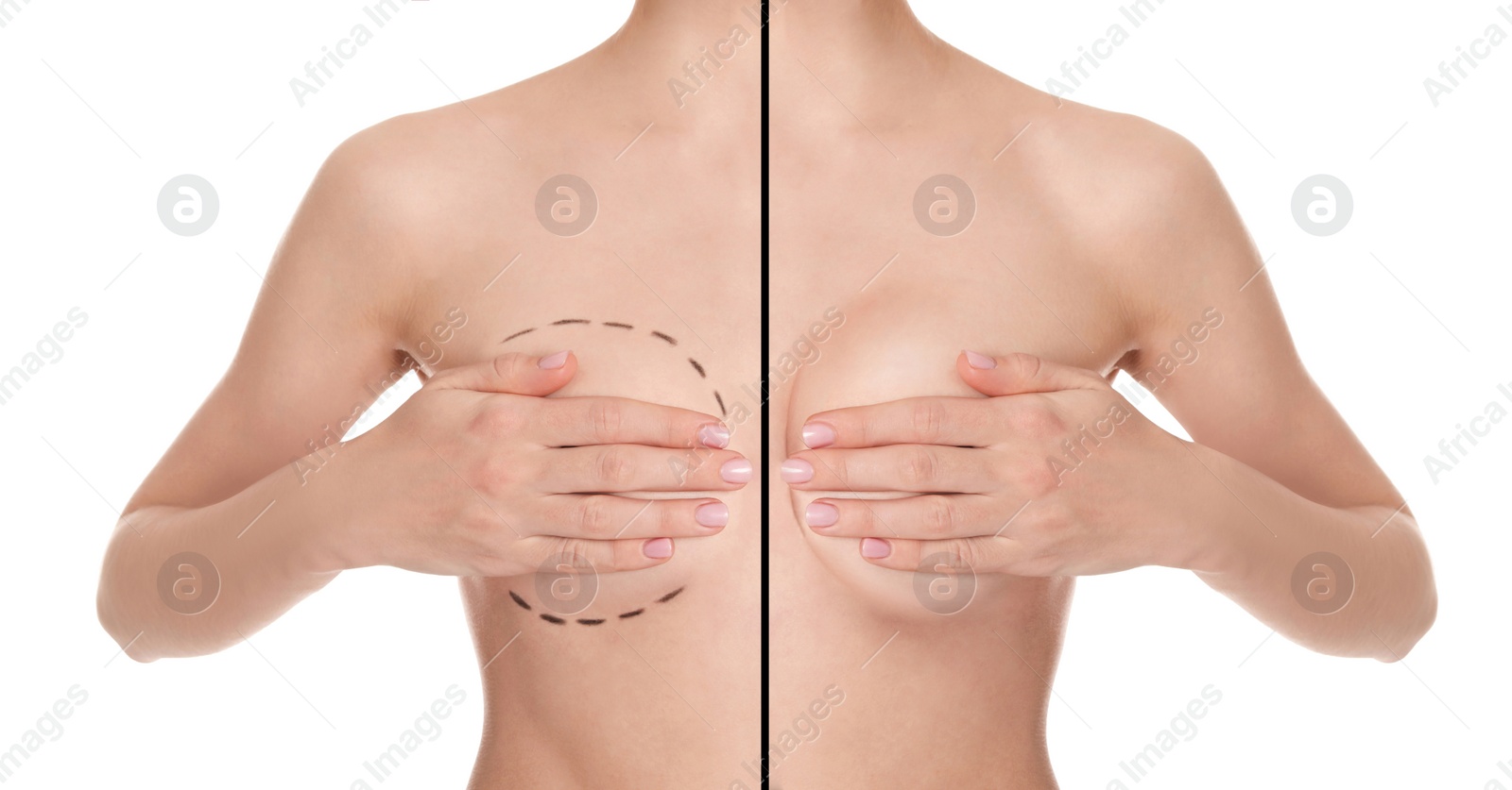 Image of Breast augmentation with silicone implant. Photo of woman divided in halves before and after plastic surgery, collage on white background