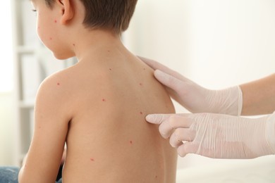 Photo of Doctor examining little boy with chickenpox in clinic, closeup. Varicella zoster virus