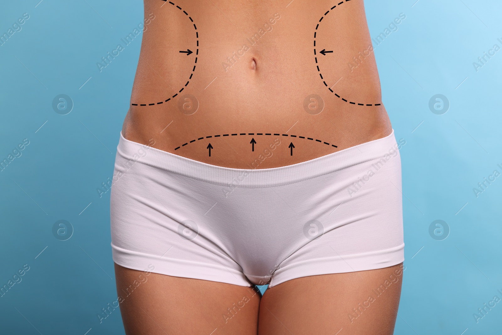Image of Woman with markings for cosmetic surgery on her abdomen against light blue background, closeup