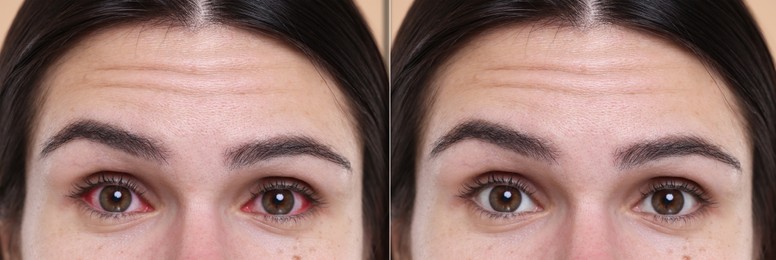 Image of Before and after conjunctivitis treatment. Photos of woman with red and healthy eyes, collage