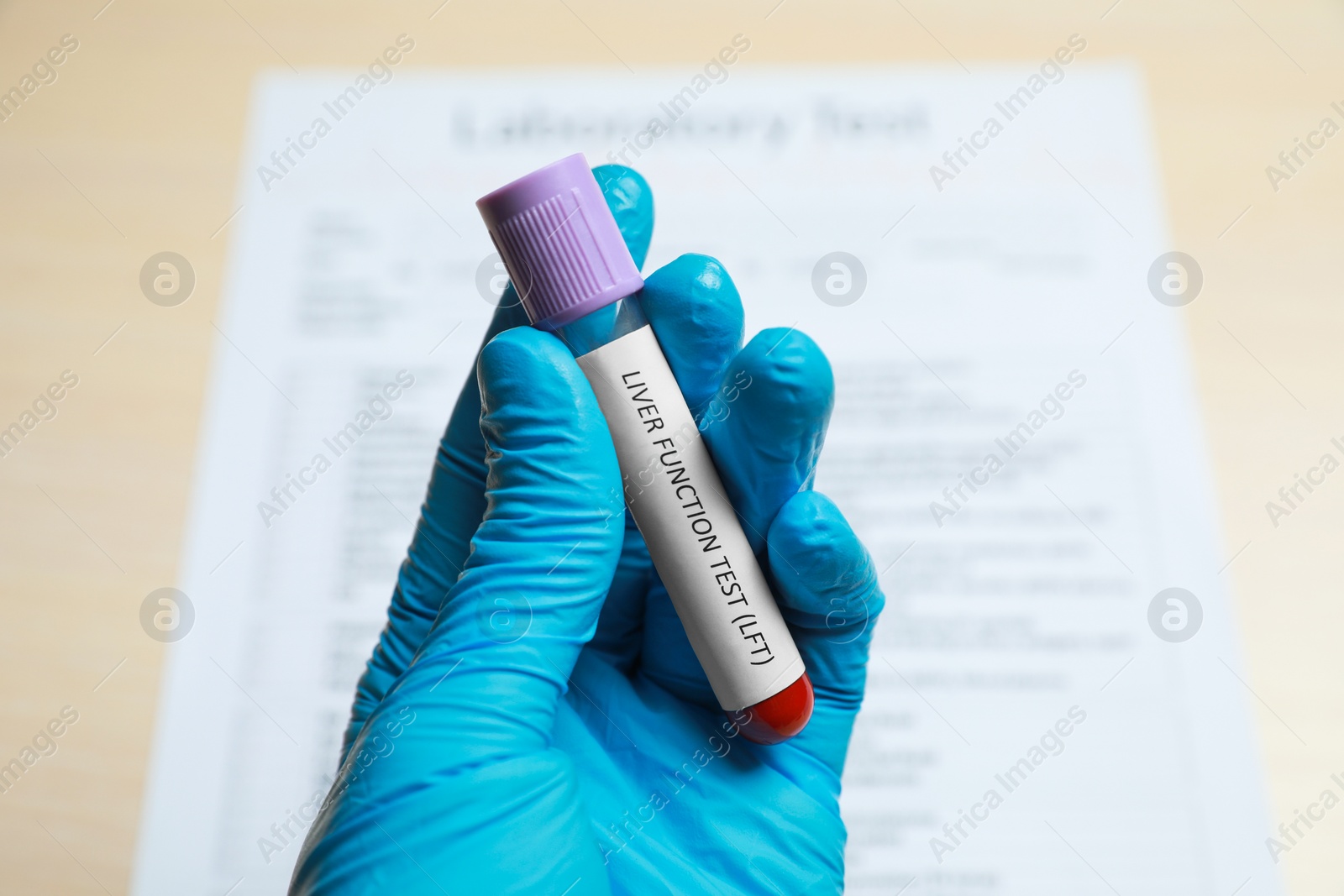 Photo of Laboratory worker holding tube with blood sample and label Liver Function Test over table, closeup