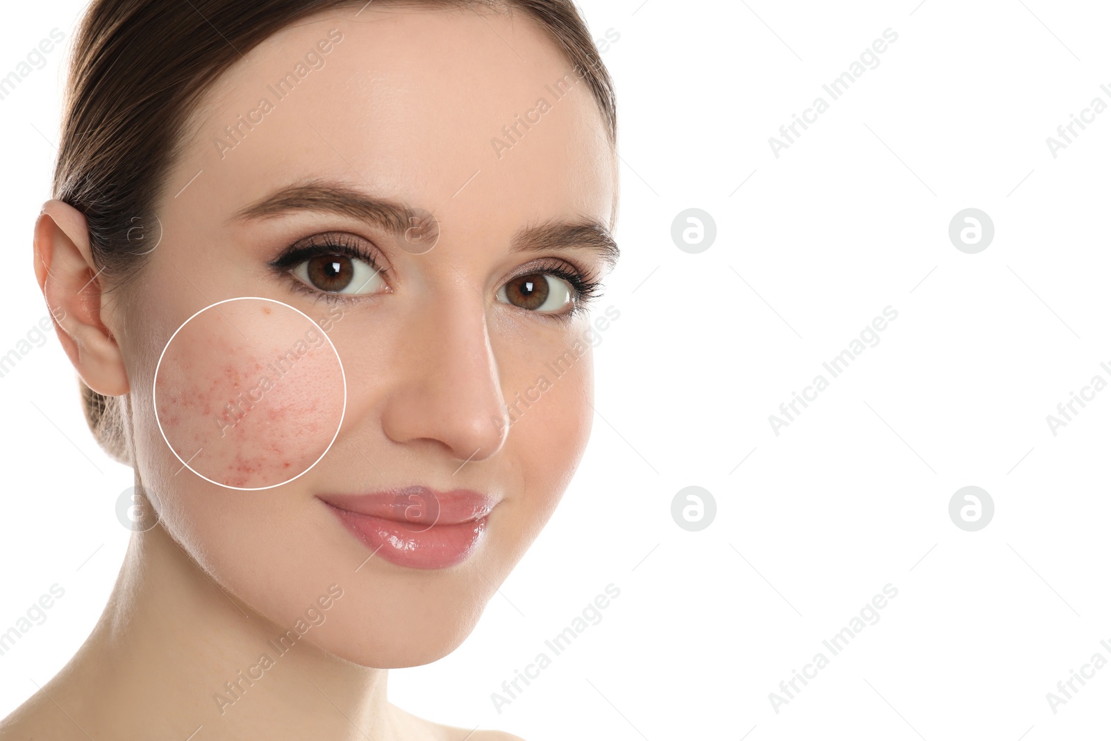 Image of Dermatology. Woman with skin problem on white background. Zoomed area showing acne