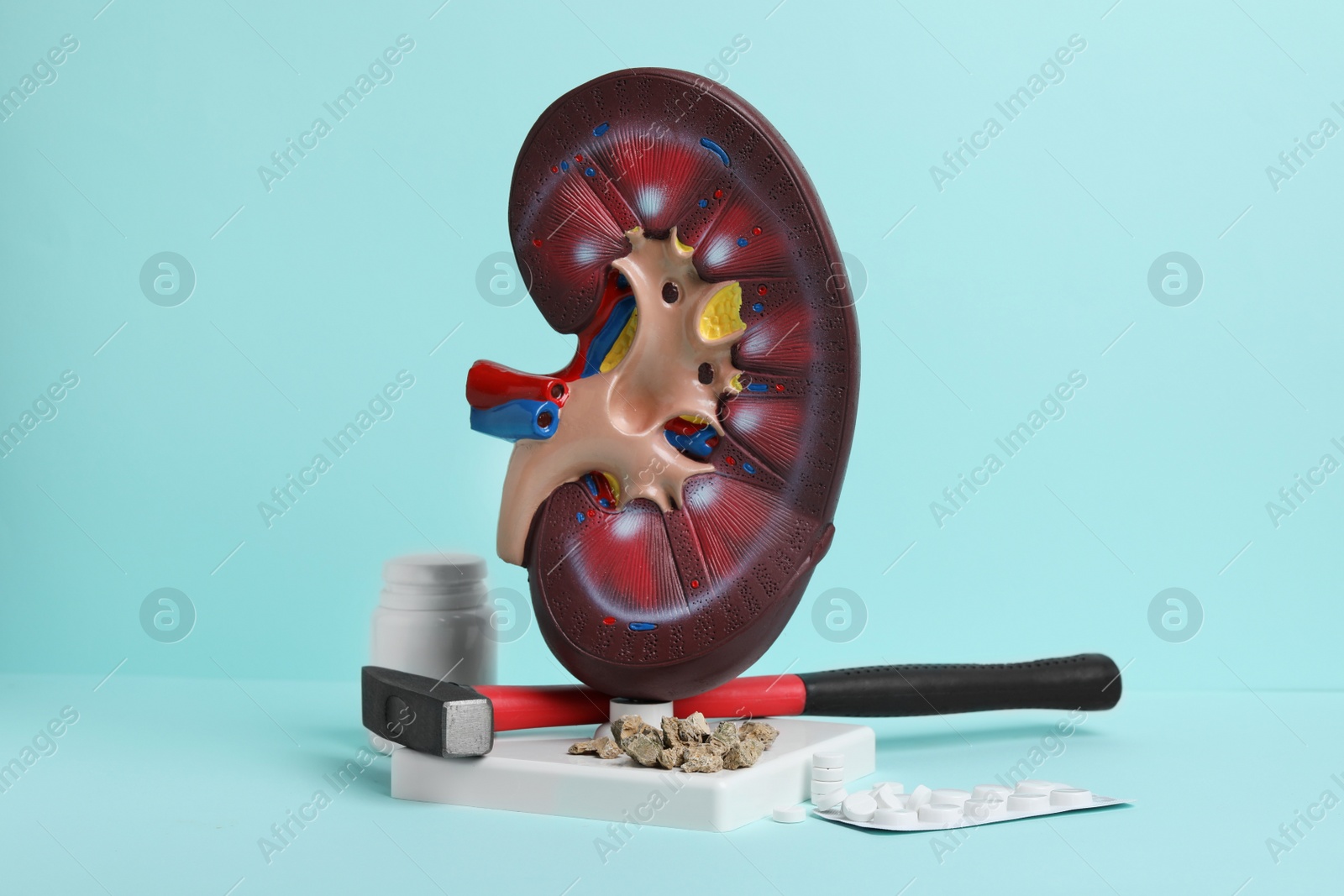 Photo of Kidney model with stones, hammer and pills on turquoise background