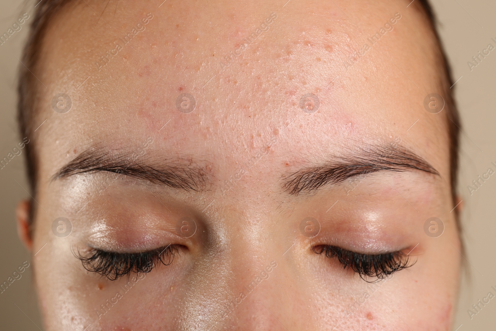 Photo of Teenage girl with acne problem on beige background, closeup