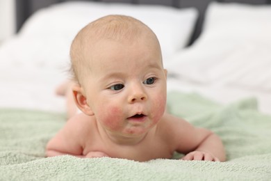 Photo of Cute little baby with allergic redness on cheeks lying on bed at home