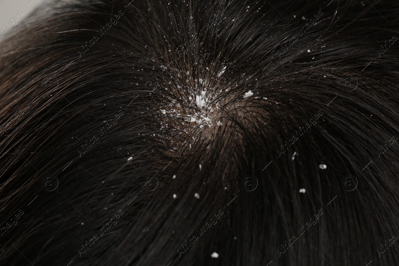 Photo of Woman with dandruff in her dark hair, closeup view