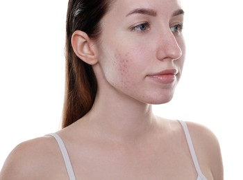 Young woman with acne problem on white background