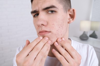 Upset young man touching pimple on his face indoors. Acne problem