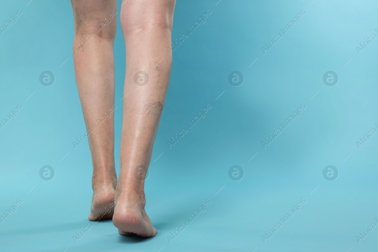 Photo of Closeup view of woman with varicose veins on light blue background. Space for text