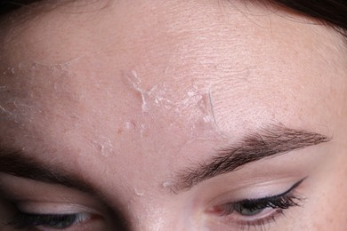 Photo of Woman with dry skin on forehead, macro view