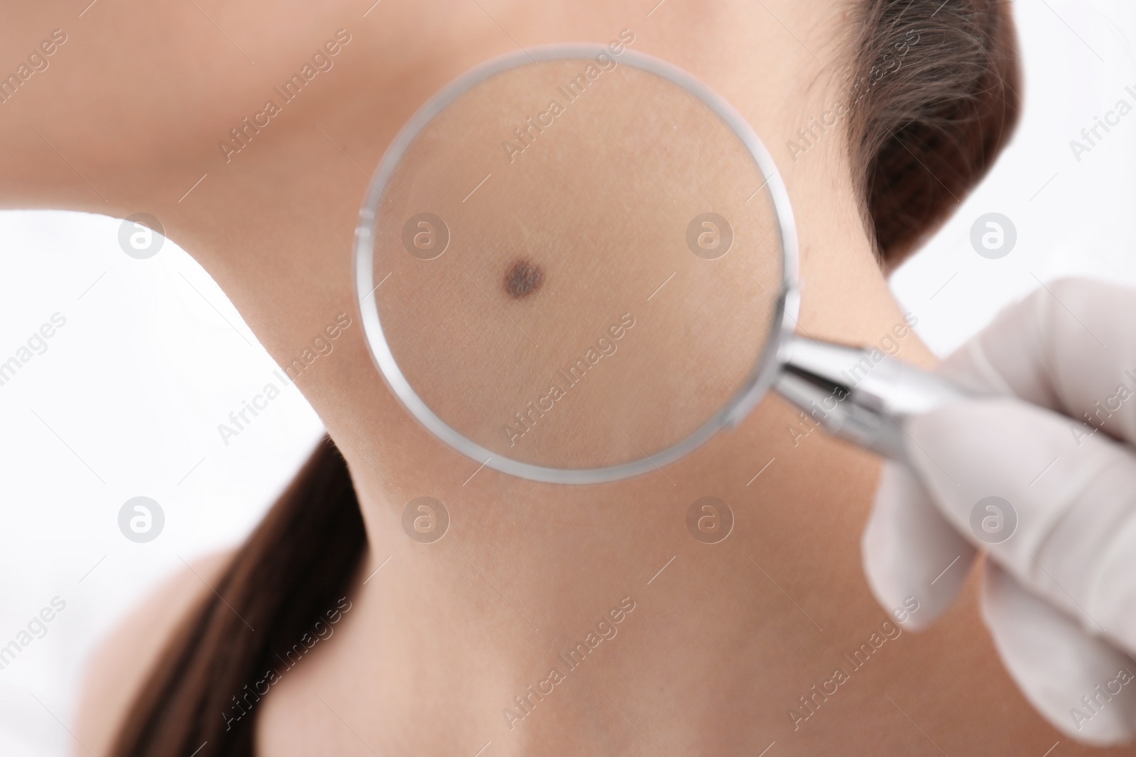 Photo of Dermatologist examining patient with magnifying glass in clinic, closeup view