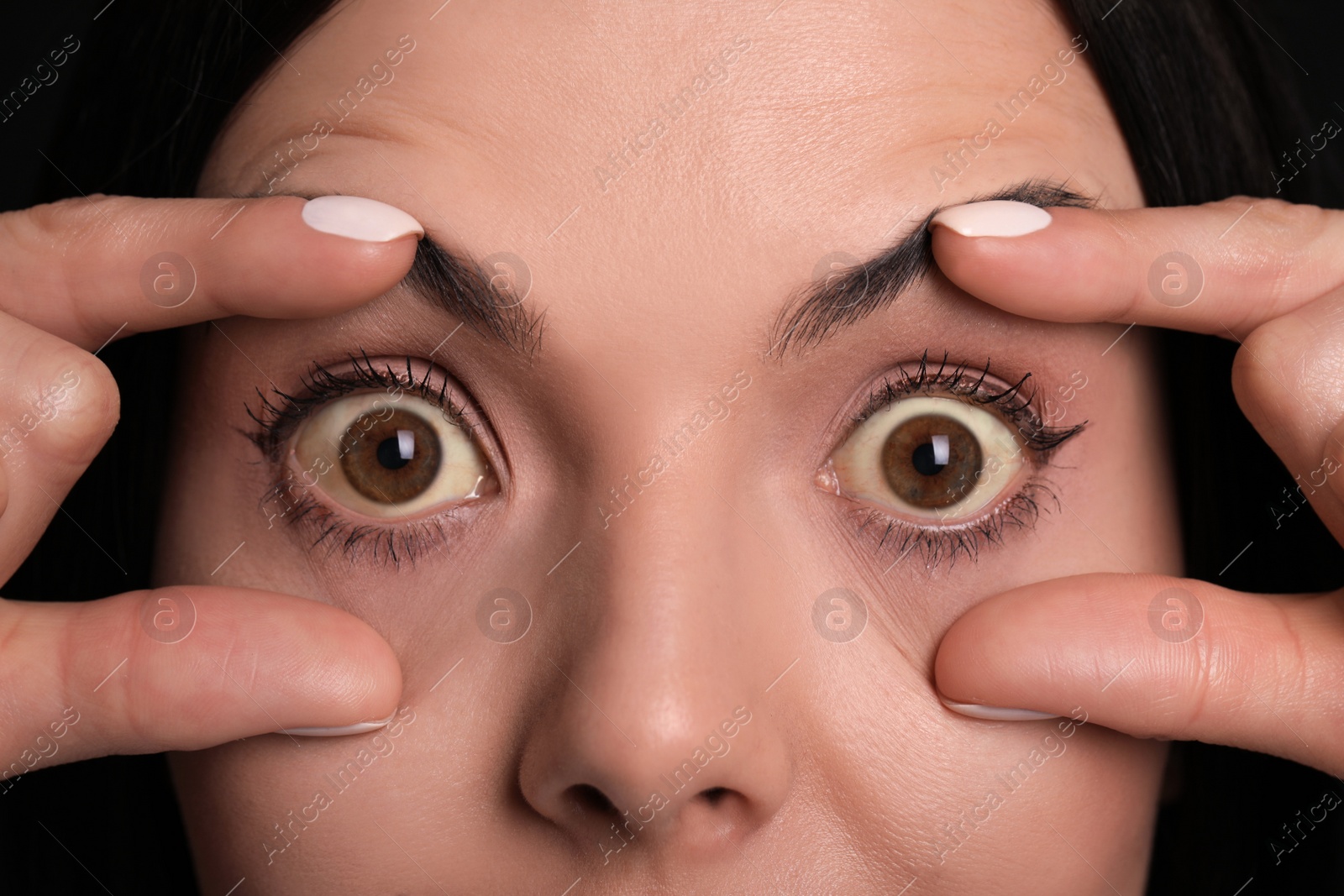 Photo of Woman checking her health condition, closeup. Yellow eyes as symptom of problems with liver