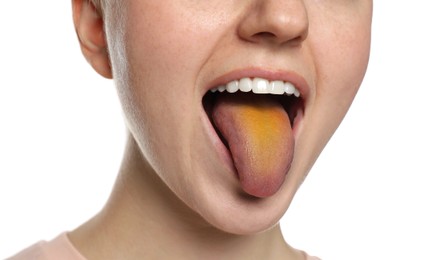 Gastrointestinal diseases. Woman showing her yellow tongue on white background, closeup