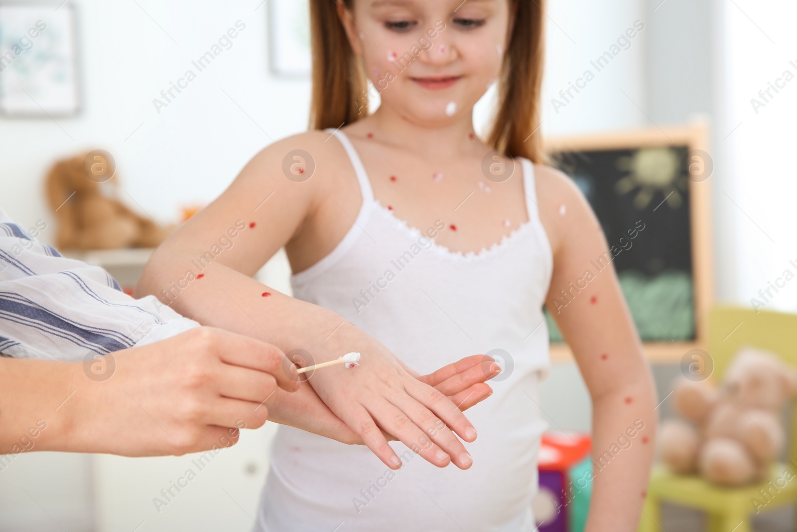 Photo of Woman applying cream onto skin of little girl with chickenpox at home