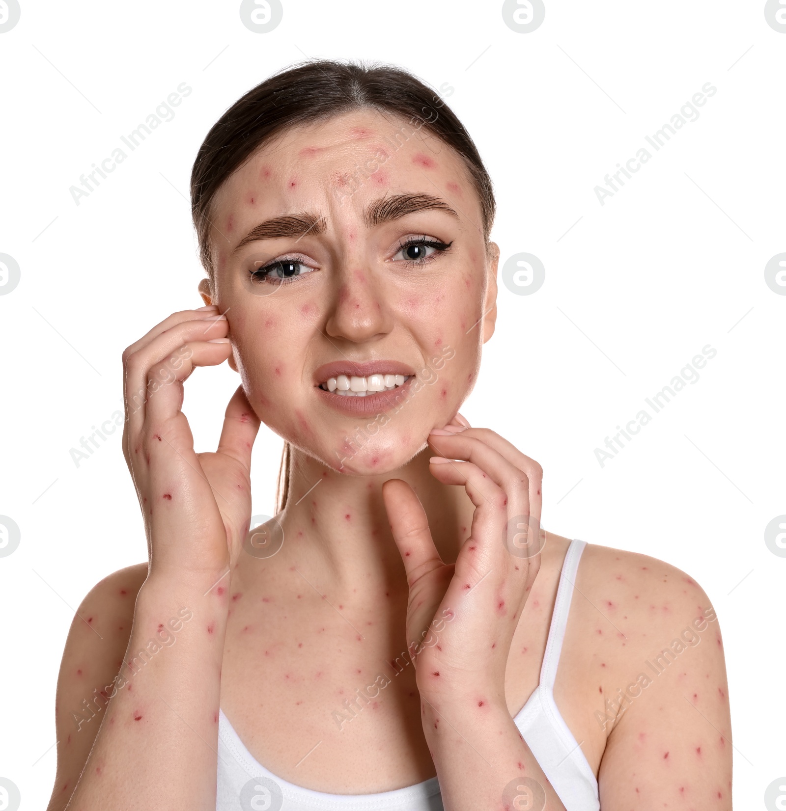 Photo of Woman with rash suffering from monkeypox virus on white background