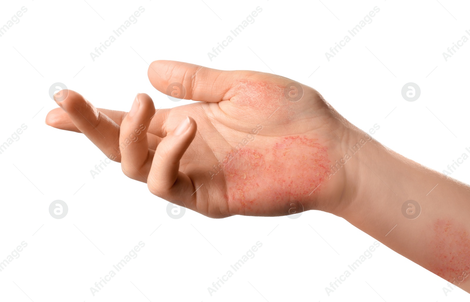 Image of Woman showing hand with dry skin on white background, closeup