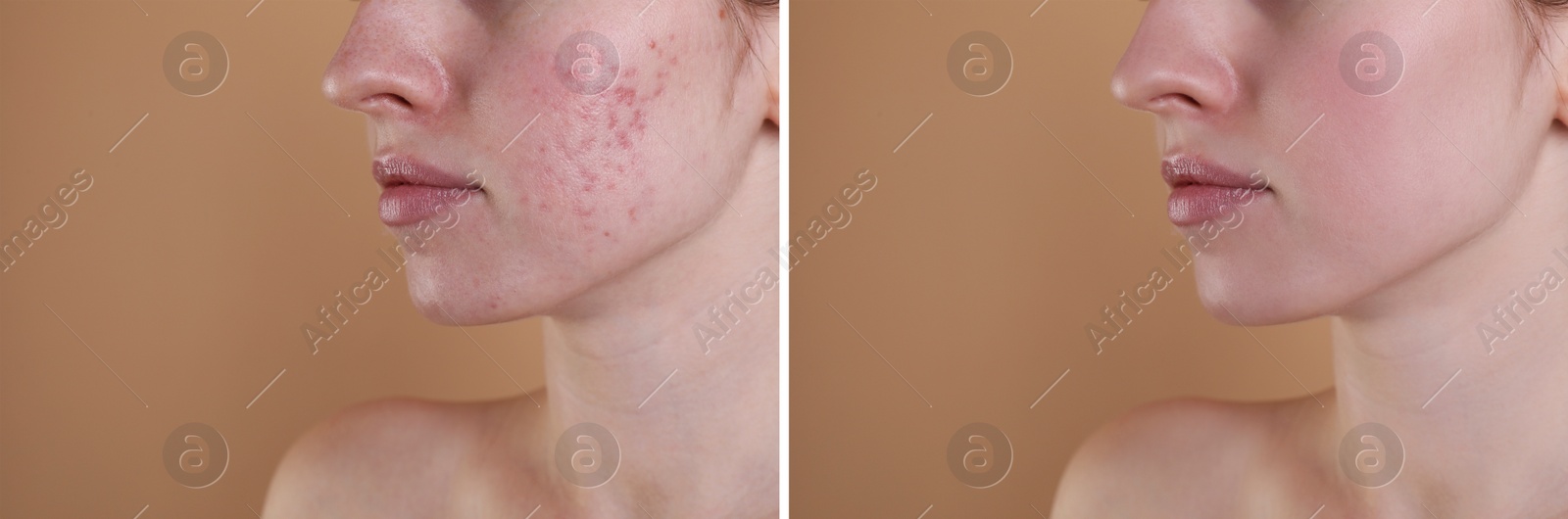 Image of Acne problem. Young woman before and after treatment on beige background, closeup. Collage of photos