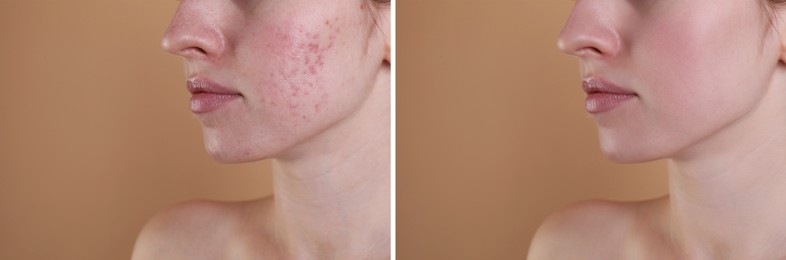 Acne problem. Young woman before and after treatment on beige background, closeup. Collage of photos