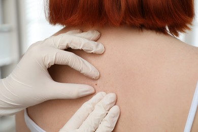 Photo of Dermatologist examining patient's birthmark in clinic, closeup view