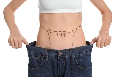 Photo of Young woman with marks on belly in big jeans after cosmetic surgery operation against white background