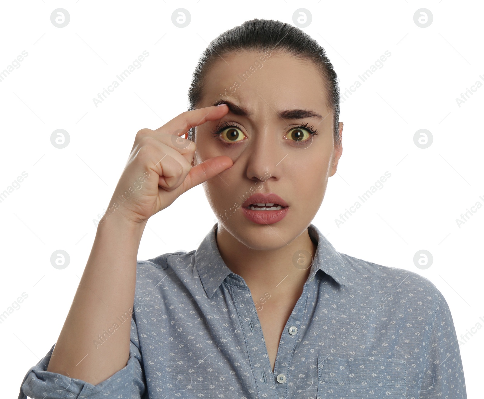 Photo of Woman checking her health condition on white background. Yellow eyes as symptom of problems with liver