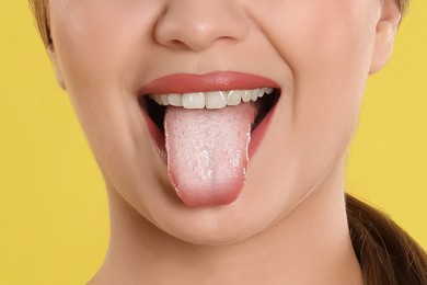 Image of Young woman showing tongue with white patches on yellow background, closeup. Oral candidiasis (thrush) disease