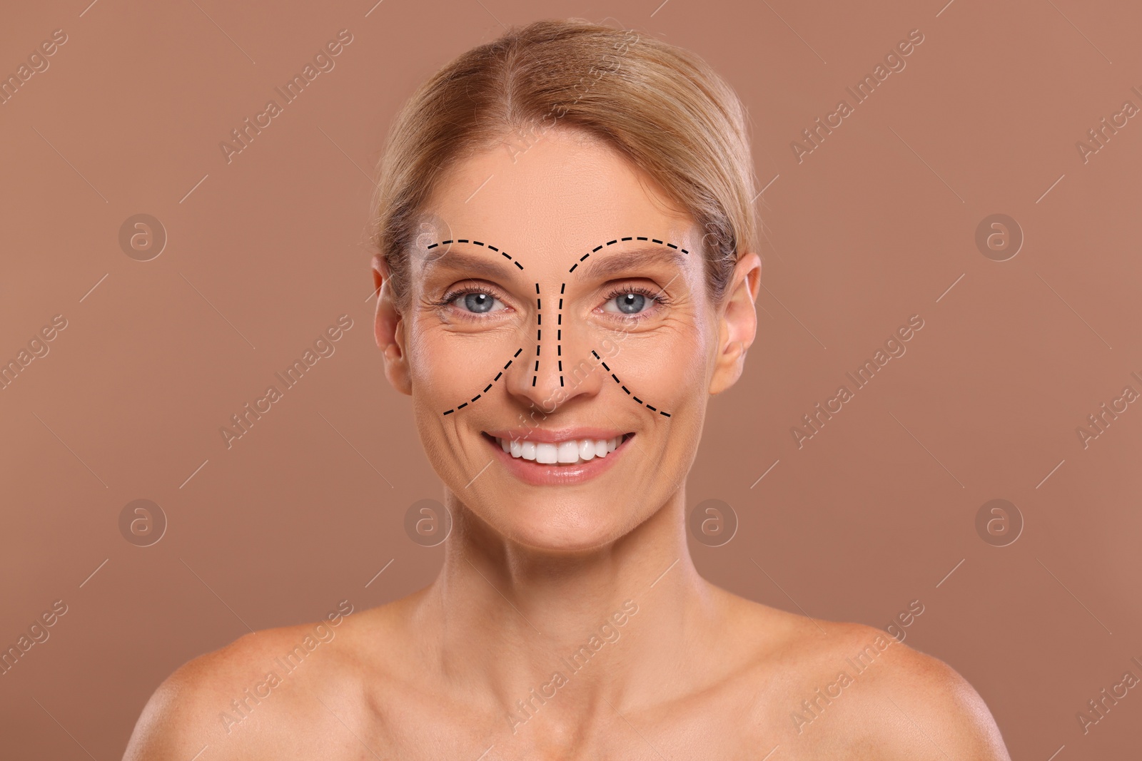 Image of Woman with markings for cosmetic surgery on her face against light brown background