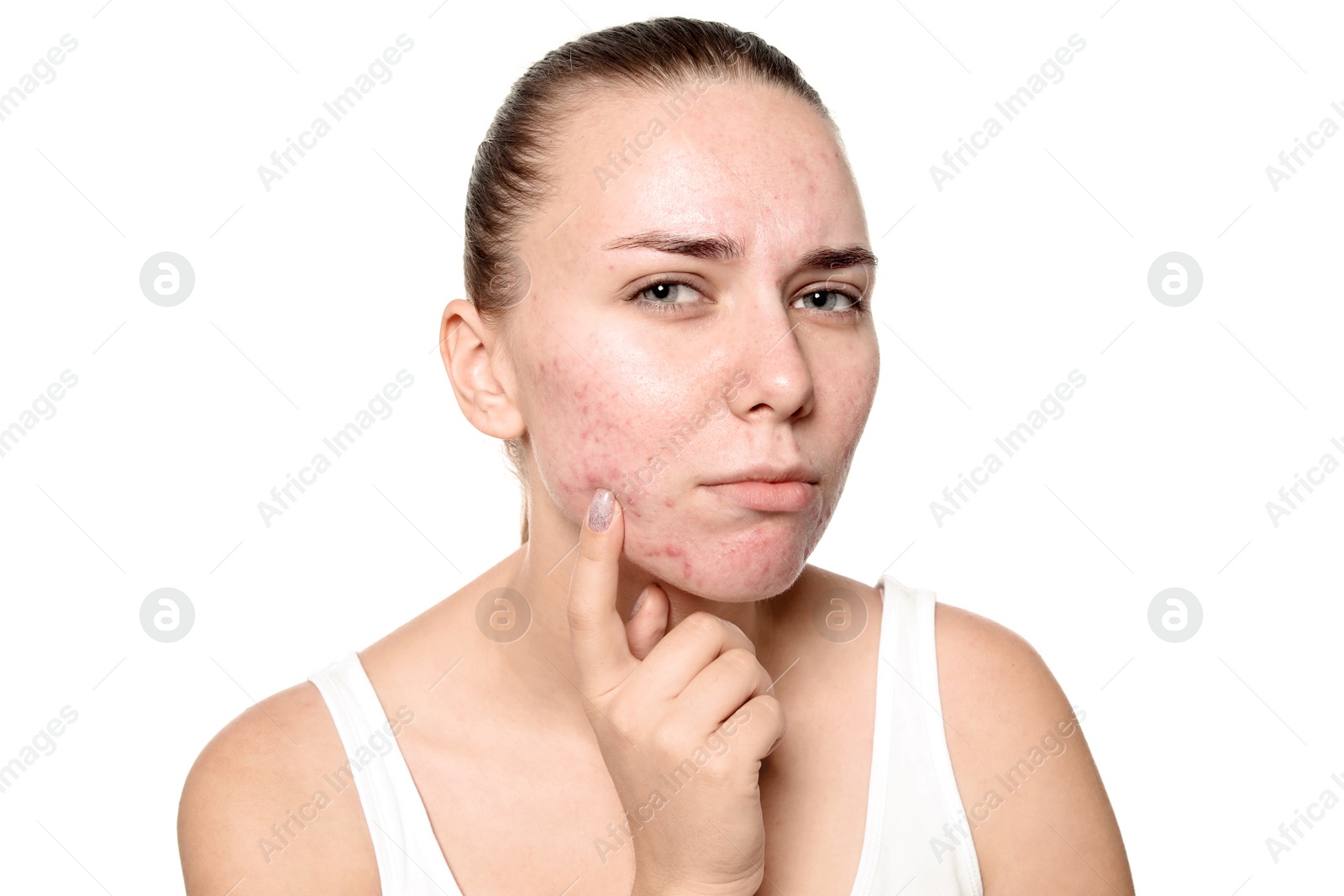 Photo of Young woman with acne problem on white background