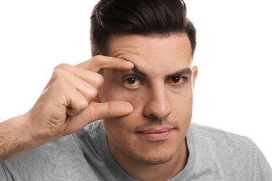 Man checking his health condition on white background, closeup. Yellow eyes as symptom of problems with liver