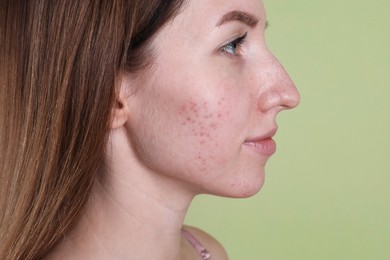 Young woman with acne problem on olive background, closeup