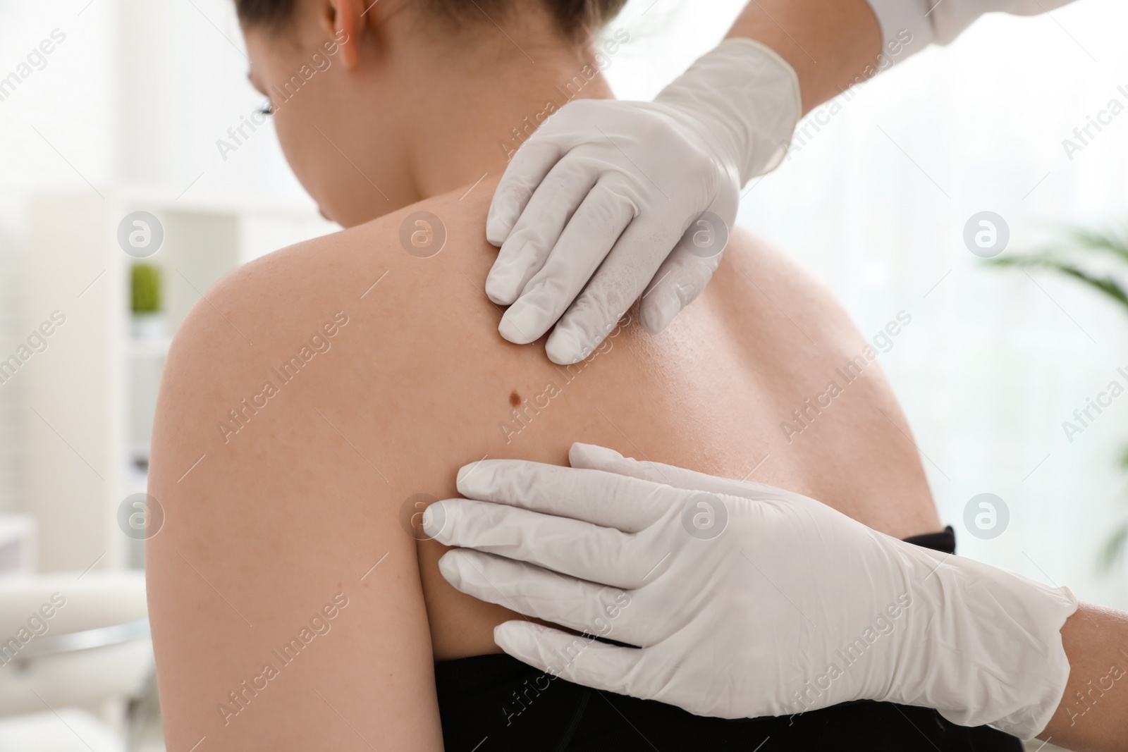 Photo of Dermatologist examining patient's birthmark in clinic, closeup