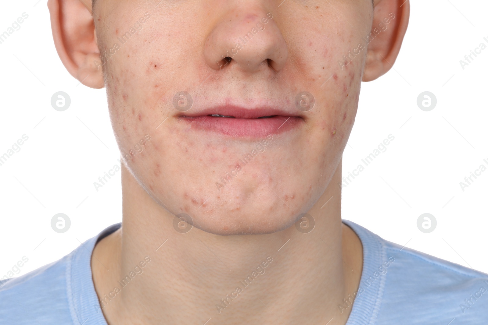 Photo of Young man with acne problem isolated on white, closeup