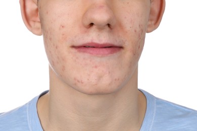 Young man with acne problem isolated on white, closeup