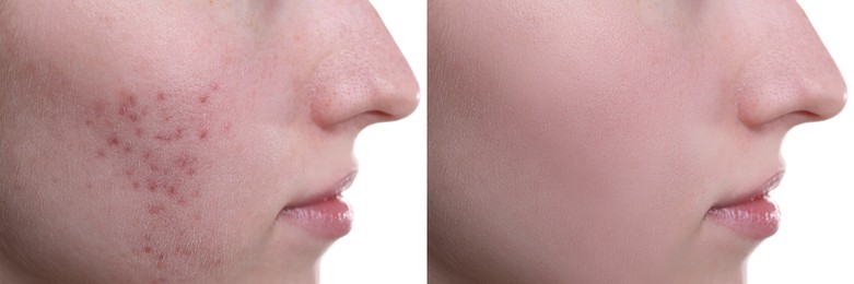 Acne problem. Young woman before and after treatment on white background, closeup. Collage of photos